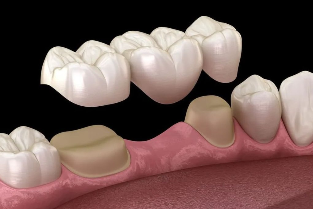 Dental Bridge illustration