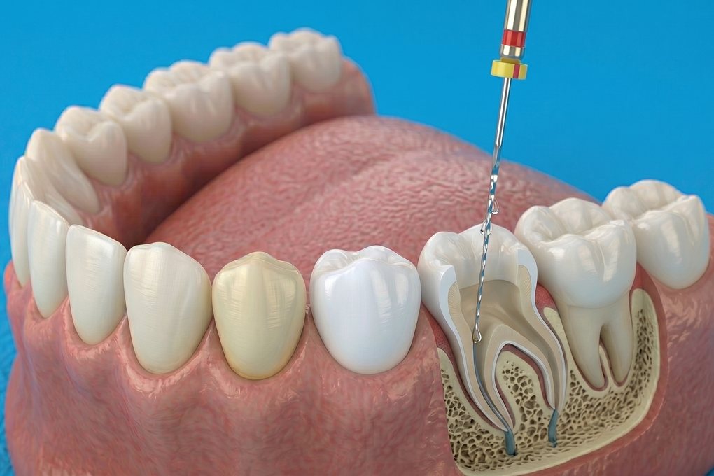 Root Canal Treatment illustration